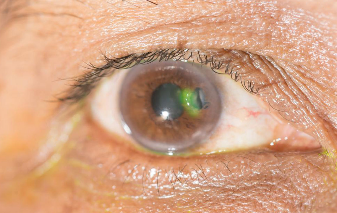 Various eye diseases and their symptoms