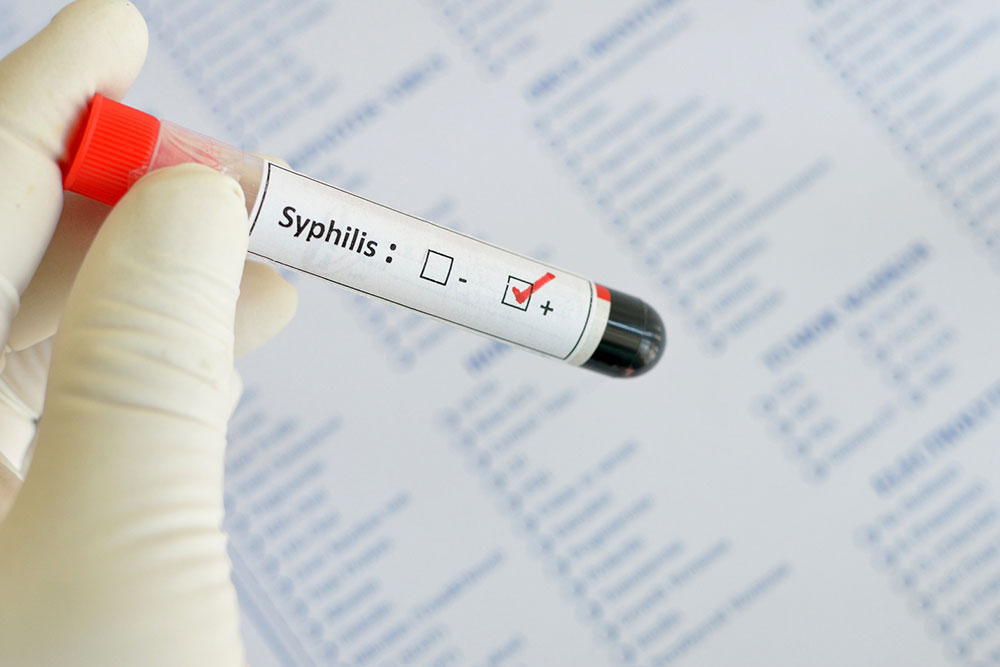 Syphilis – Early Signs and Diagnosis